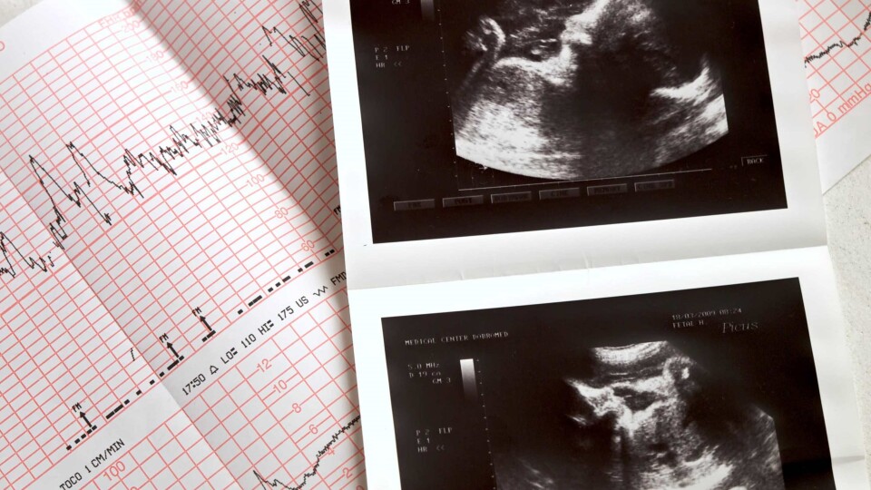Ungārijā pirms aborta veikšanas būs jāklausās bērna sirds puksti