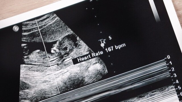 Itālijā pirms aborta veikšanas varētu likt klausīties bērna sirdspukstus