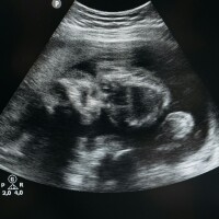 Nīderlandes parlamentārietis izsakās par abortiem